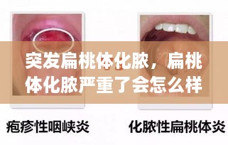 突發(fā)扁桃體化膿，扁桃體化膿嚴(yán)重了會(huì)怎么樣了 